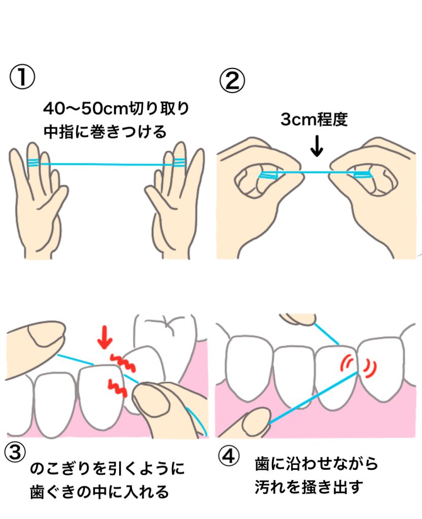 トマト薬局薬剤師のひとりごと　㊷フロス使用で脳梗塞予防？